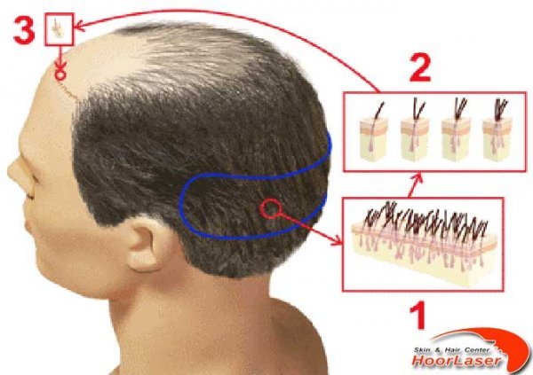  آیا موی سفید را میتوان کاشت