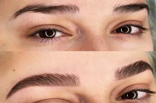  آیا موی سفید را میتوان کاشت