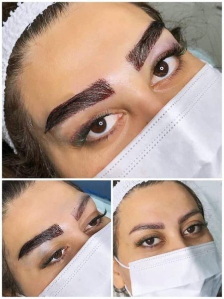  آیا موی سفید را میتوان کاشت