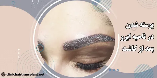  چه کسانی کاندید مناسب برای کاشت ابرو هستند