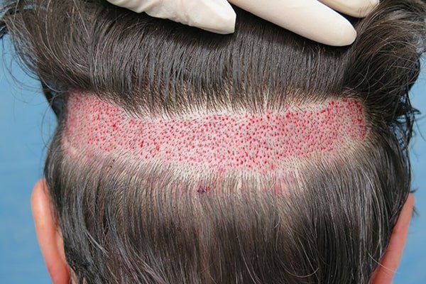  فیلم کاشت ابرو از صفر تا صد + قبل از کاشت ابرو چه داروهایی نباید خورد