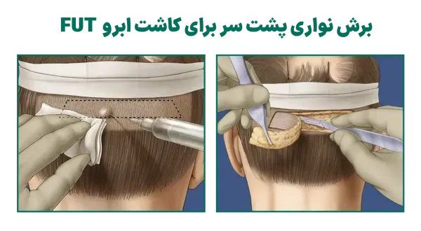  فیلم کاشت ابرو از صفر تا صد + قبل از کاشت ابرو چه داروهایی نباید خورد