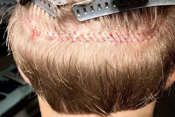  فیلم کاشت ابرو از صفر تا صد + قبل از کاشت ابرو چه داروهایی نباید خورد