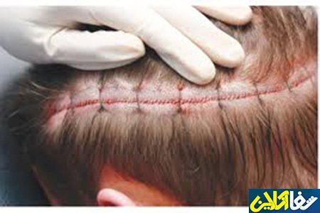  فیلم کاشت ابرو از صفر تا صد + قبل از کاشت ابرو چه داروهایی نباید خورد