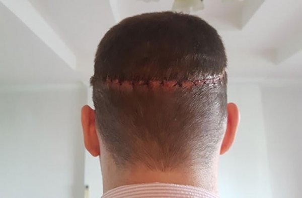  فیلم کاشت ابرو از صفر تا صد + قبل از کاشت ابرو چه داروهایی نباید خورد