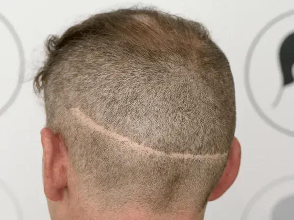  فیلم کاشت ابرو از صفر تا صد + قبل از کاشت ابرو چه داروهایی نباید خورد