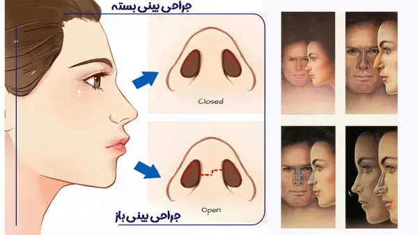  فیلم عمل بینی دختر ۱۶ ساله+فیلم جراحی بینی عروسکی