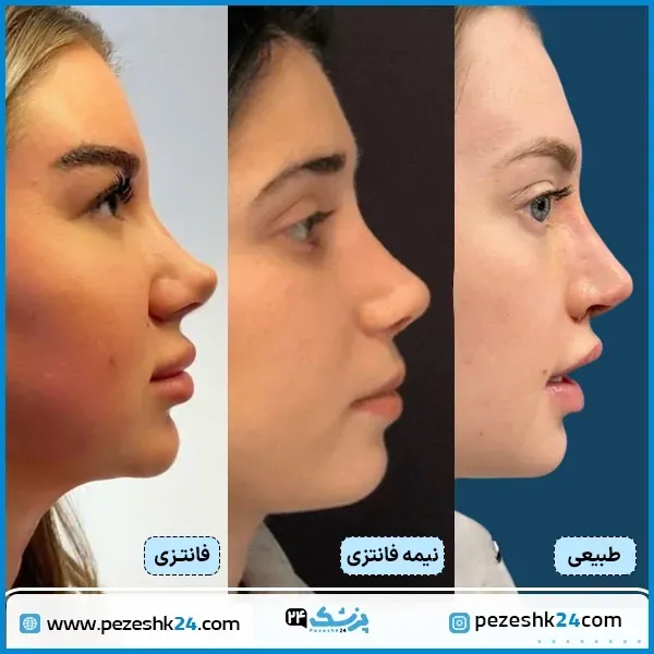  فیلم عمل بینی دختر ۱۶ ساله+فیلم جراحی بینی عروسکی