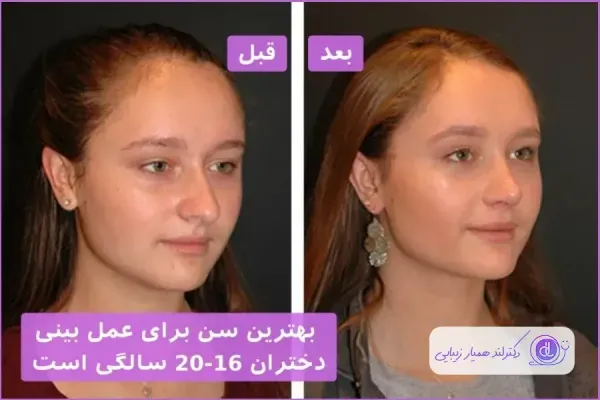  فیلم عمل بینی دختر ۱۶ ساله+فیلم جراحی بینی عروسکی