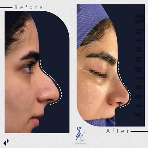  فیلم عمل بینی دختر ۱۶ ساله+فیلم جراحی بینی عروسکی