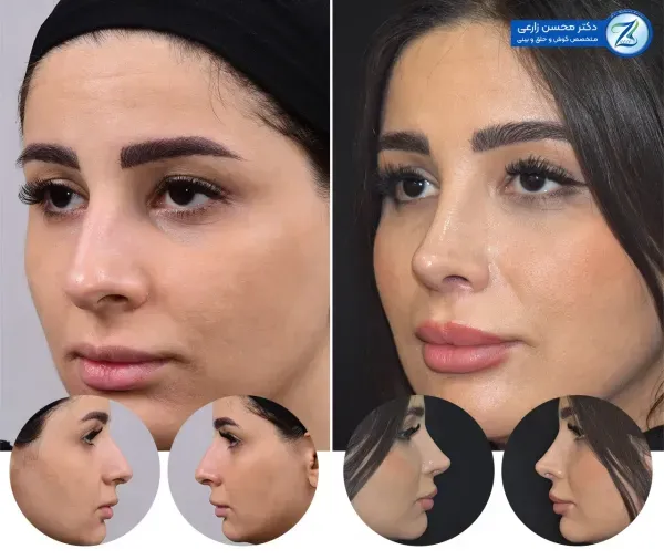  فیلم عمل بینی دختر ۱۶ ساله+فیلم جراحی بینی عروسکی