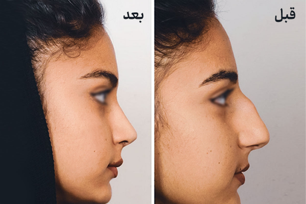  فیلم عمل بینی دختر ۱۶ ساله+فیلم جراحی بینی عروسکی