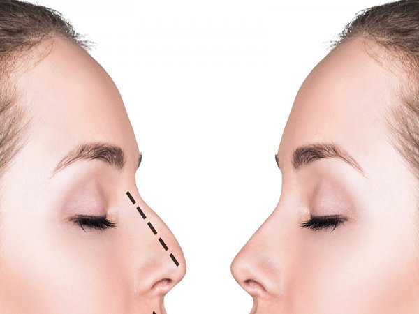  فیلم عمل بینی دختر ۱۶ ساله+فیلم جراحی بینی عروسکی