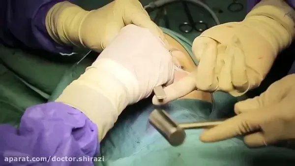  فیلم عمل بینی دختر ۱۶ ساله+فیلم جراحی بینی عروسکی