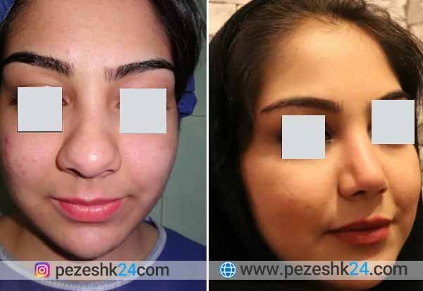  عکس بینی فانتزی عروسکی+مدل بینی فانتزی گوشتی