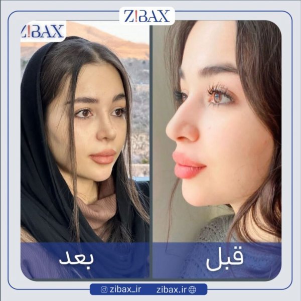 عکس دماغ زیبا + عکس بینی عمل شده زیبا