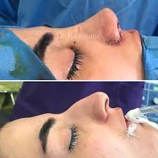  عکس دماغ زیبا + عکس بینی عمل شده زیبا