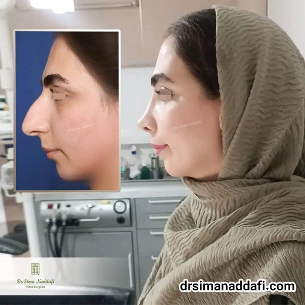  عکس دماغ زیبا + عکس بینی عمل شده زیبا