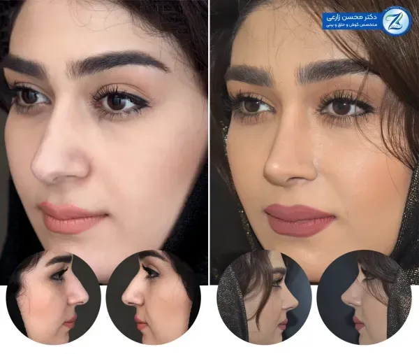  عکس دماغ زیبا + عکس بینی عمل شده زیبا