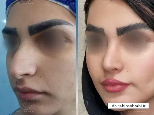 مدت زمان عمل بینی استخوانی