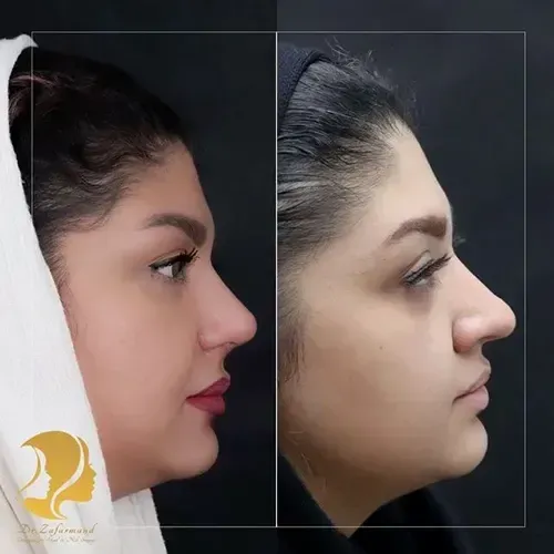  مدت زمان عمل بینی استخوانی