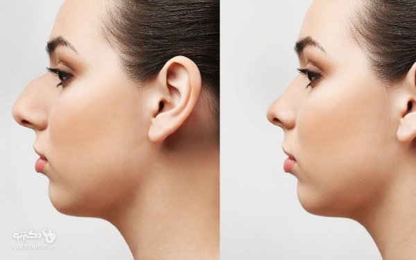  هزینه جراحی بینی چقدر است؟