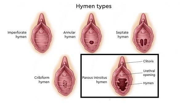  آیا پرده بکارت خود به خود ترمیم می‌شود+هزينه ترميم بكارت با ليزر سال 1404