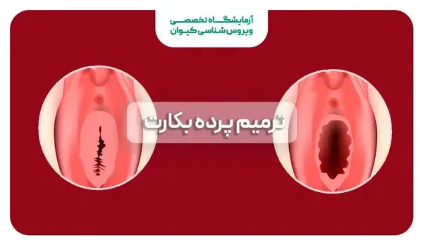  آیا پرده بکارت خود به خود ترمیم می‌شود+هزينه ترميم بكارت با ليزر سال 1404