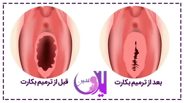  آیا پرده بکارت خود به خود ترمیم می‌شود+هزينه ترميم بكارت با ليزر سال 1404