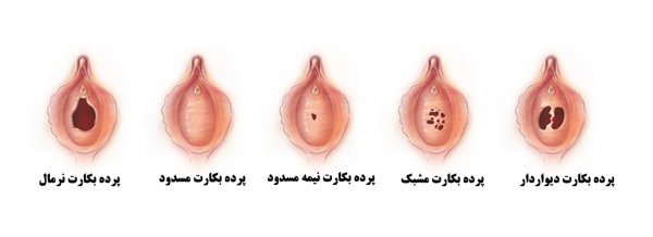  آیا پرده بکارت خود به خود ترمیم می‌شود+هزينه ترميم بكارت با ليزر سال 1404