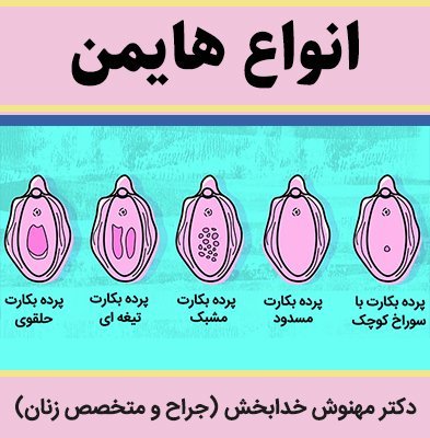  سوالات درباره ترميم بكارت هایمن