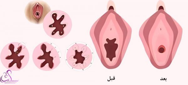  سوالات درباره ترميم بكارت هایمن