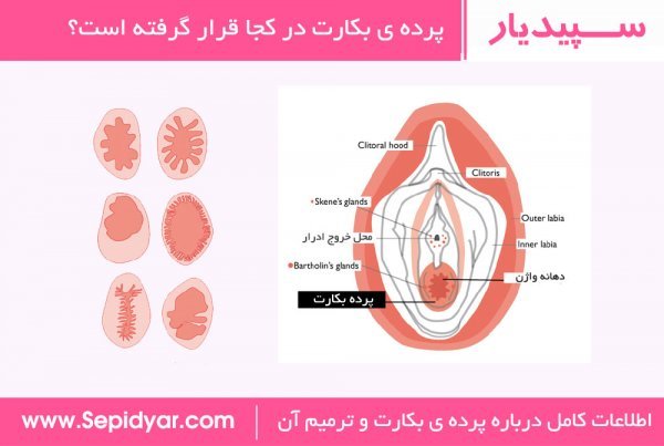 سوالات درباره ترميم بكارت هایمن