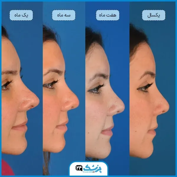  عمل بینی دماغ گوشتی در چه سنی مناسب است؟