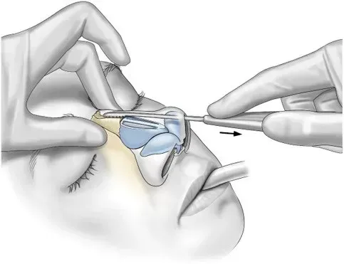  عمل بینی دماغ گوشتی در چه سنی مناسب است؟
