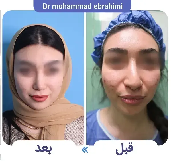 هزینه عمل بینی پهن و گوشتی 1404