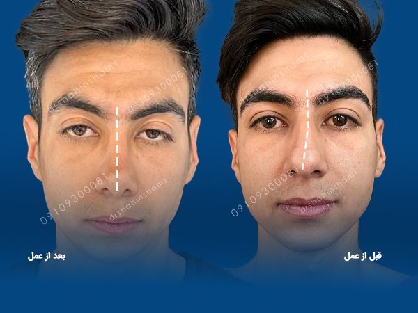  هزینه عمل بینی پهن و گوشتی 1404