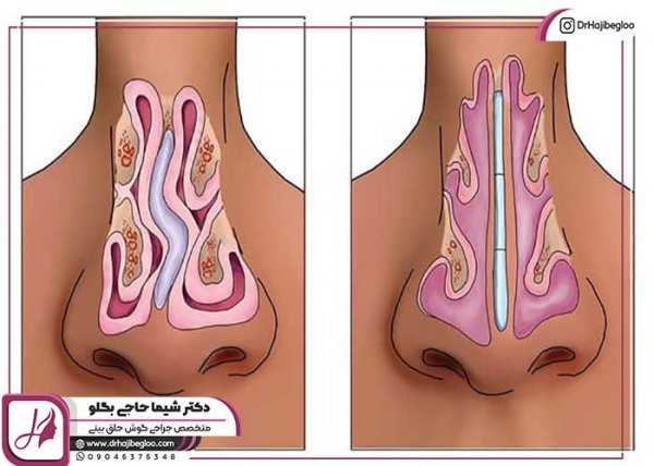  هزینه عمل بینی پهن و گوشتی 1404
