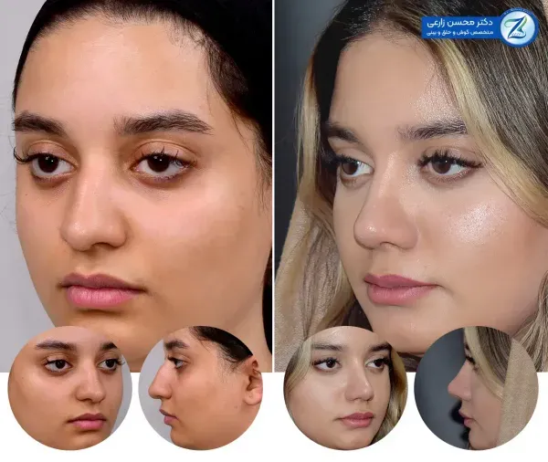  هزینه عمل بینی پهن و گوشتی 1404