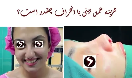  هزینه عمل بینی پهن و گوشتی 1404