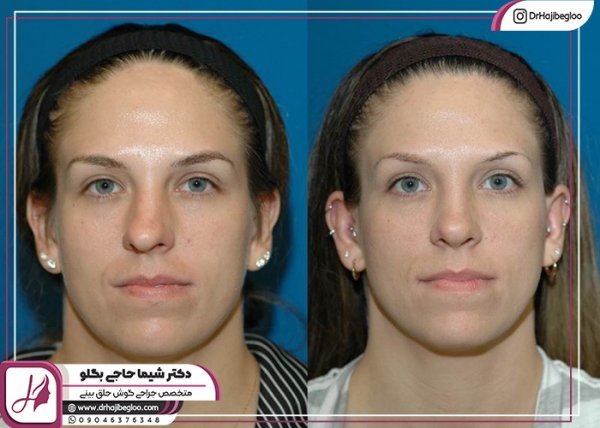  هزینه عمل بینی پهن و گوشتی 1404