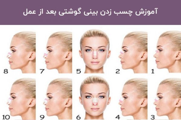  فیلم نحوه چسب زدن بینی استخوانی