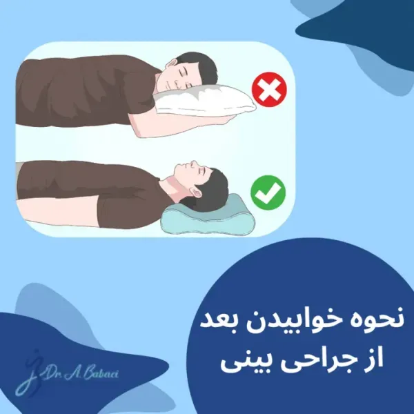  چه مدت بعد از عمل بینی میتوان رابطه جنسی سکس داشت