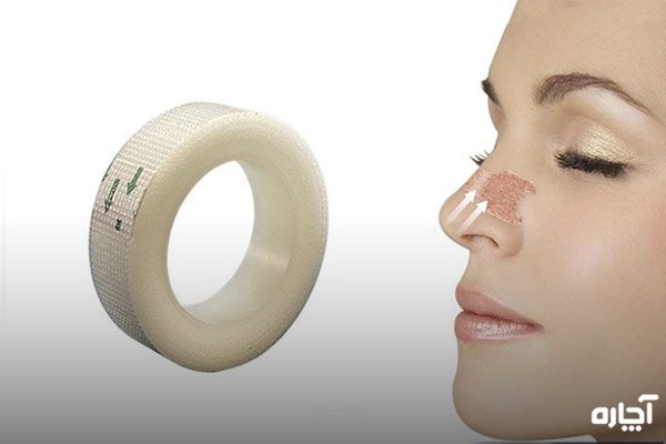  چه مدت بعد از عمل بینی میتوان رابطه جنسی سکس داشت