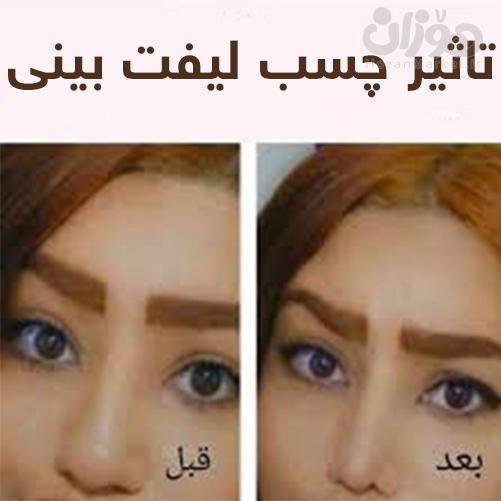  چه مدت بعد از عمل بینی میتوان رابطه جنسی سکس داشت