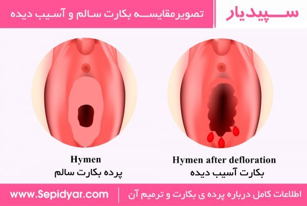  شکل پرده بکارت هایمن طبیعی