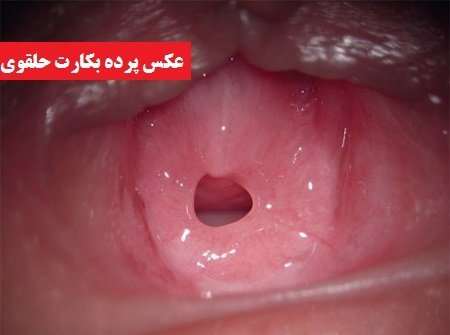  شکل پرده بکارت هایمن طبیعی