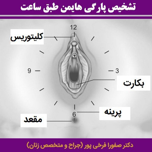  چگونه بفهمیم پرده بکارت سالم است با عکس