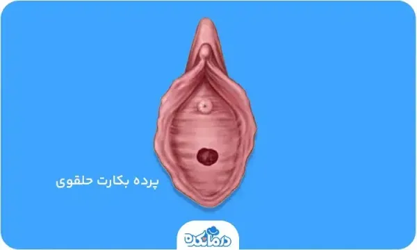  محل پرده بکارت هایمن با عکس