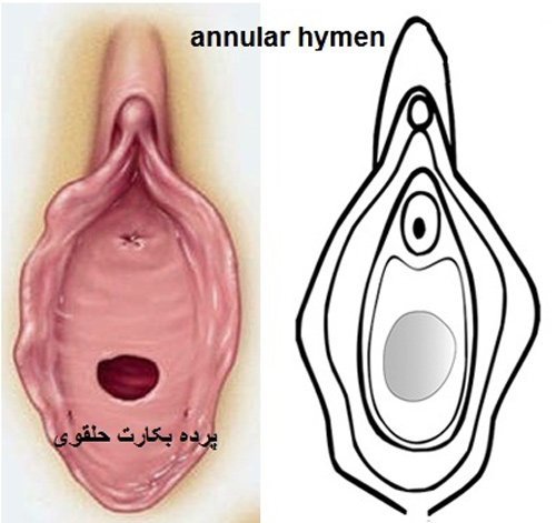  محل پرده بکارت هایمن با عکس